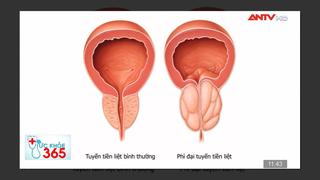 Tăng sinh lành tính tuyến tiền liệt